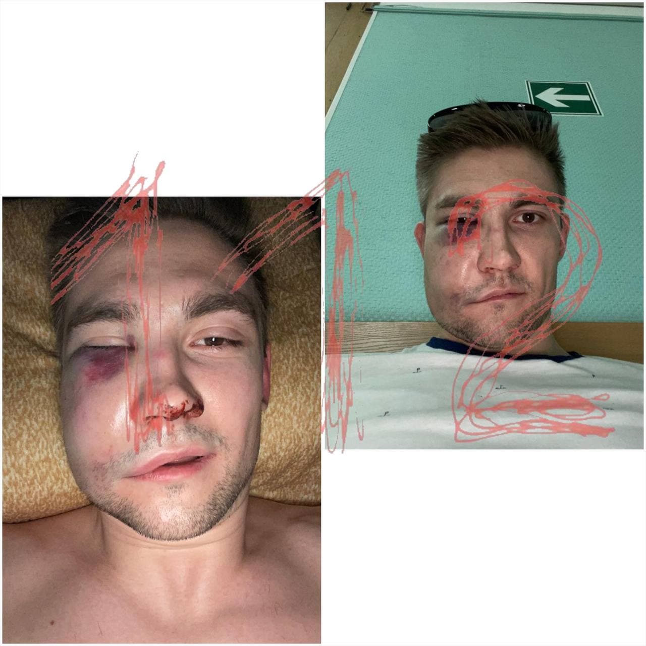 Фото избитого Антипова. 112